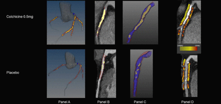 Effect of low-dose colchicine on pericoronary inflammation and coronary plaque composition in chronic coronary disease: a subanalysis of the LoDoCo2 trial