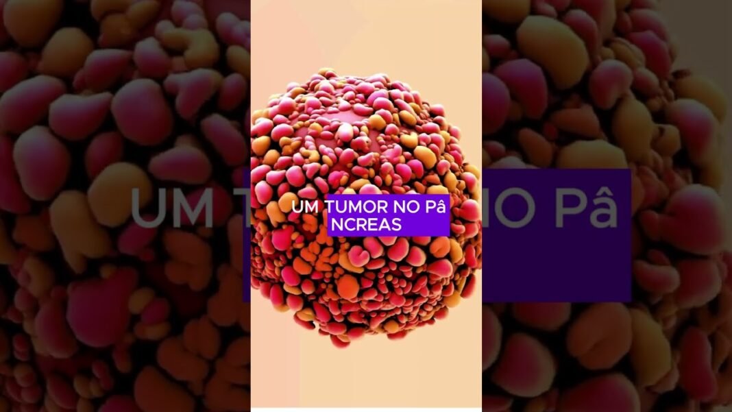 Câncer de pâncreas #curiosidades #cancer
