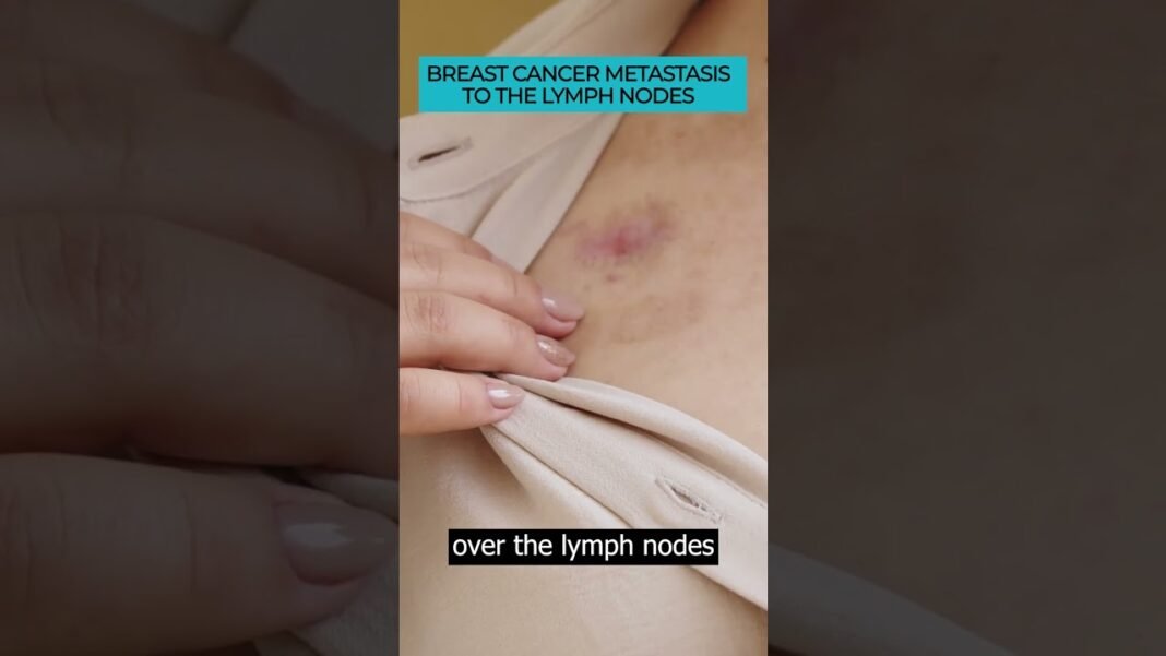 Spotting Symptoms of Breast Cancer Metastasis to Lymph Nodes 🎗️🔍#Cancer #Metastasis #cancerawareness