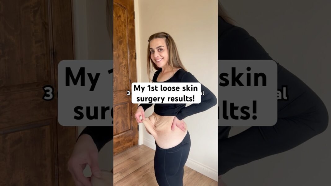 Patience was essential throughout my weight loss journey… and now it's building my recovery. 💜