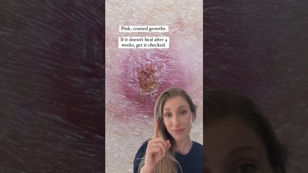 ❗️Skin cancer awareness month❗️| #SHORTS