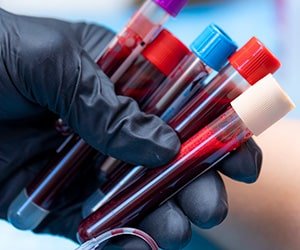 What Is Smoldering Myeloma? | Blog