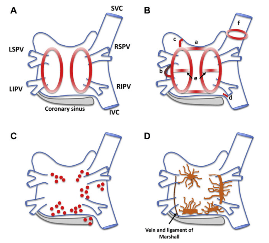 How often PV ablation converts AF to AT ?