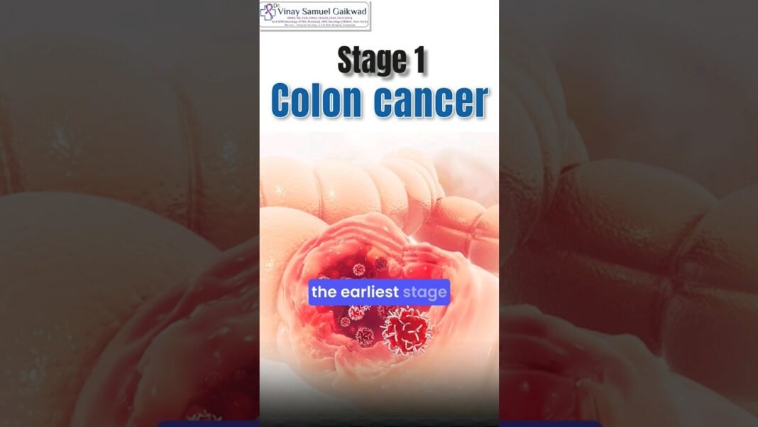 Stage 1 Colon Cancer(What You Should Know) #coloncancer